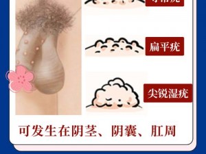 男性 hpv 真实图片——有效预防 HPV 感染的男性健康产品