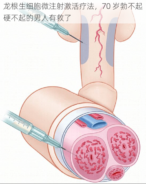 龙根生细胞微注射激活疗法，70 岁勃不起硬不起的男人有救了