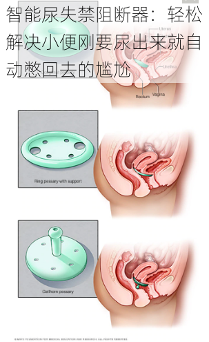 智能尿失禁阻断器：轻松解决小便刚要尿出来就自动憋回去的尴尬